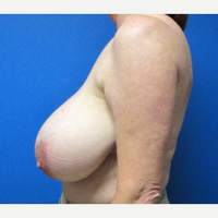 Breast-Reduction-before-2817649-2660006.png
