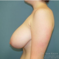 Breast-Reduction-before-1711798-2223293.png