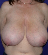 Breast-reduction-before-213158-485857.png