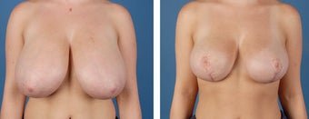 Breast-reduction-after-355748.jpg