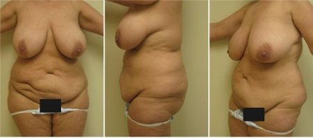 Breast_Reduction_Examples.jpg