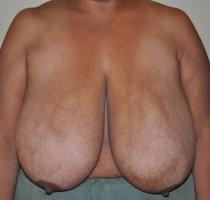 Breast-reduction-before-614434-714856.jpg
