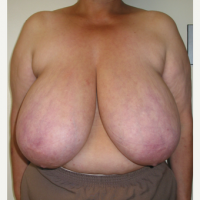 Breast-Reduction-before-2784240-2649491.png