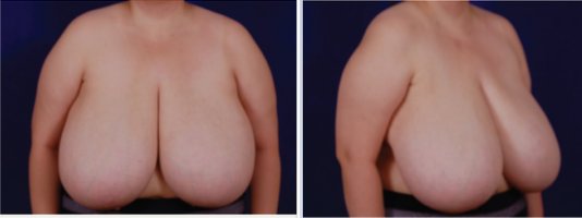 Breast-Reduction-before-3439241-2784349.jpg