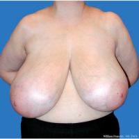 Breast-Reduction-before-2869271-2676768.png