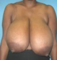 Breast-Reduction-before-1488704-2108461.png
