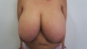 Breast-Reduction-before-1208873-KKcups.jpg