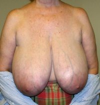 Breast-Reduction-before-296025.jpg