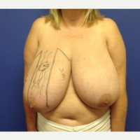 Breast-Reduction-before-2661610-2609983.jpeg