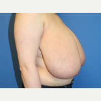 Breast-Reduction-before-3550354-2806465.png