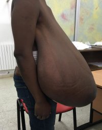 Gigantomastia-in-a-38-years-old-woman-before-mammoplasty-lateral-view.jpg