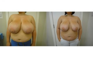 breast-reduction-by-liposuction-1.jpg